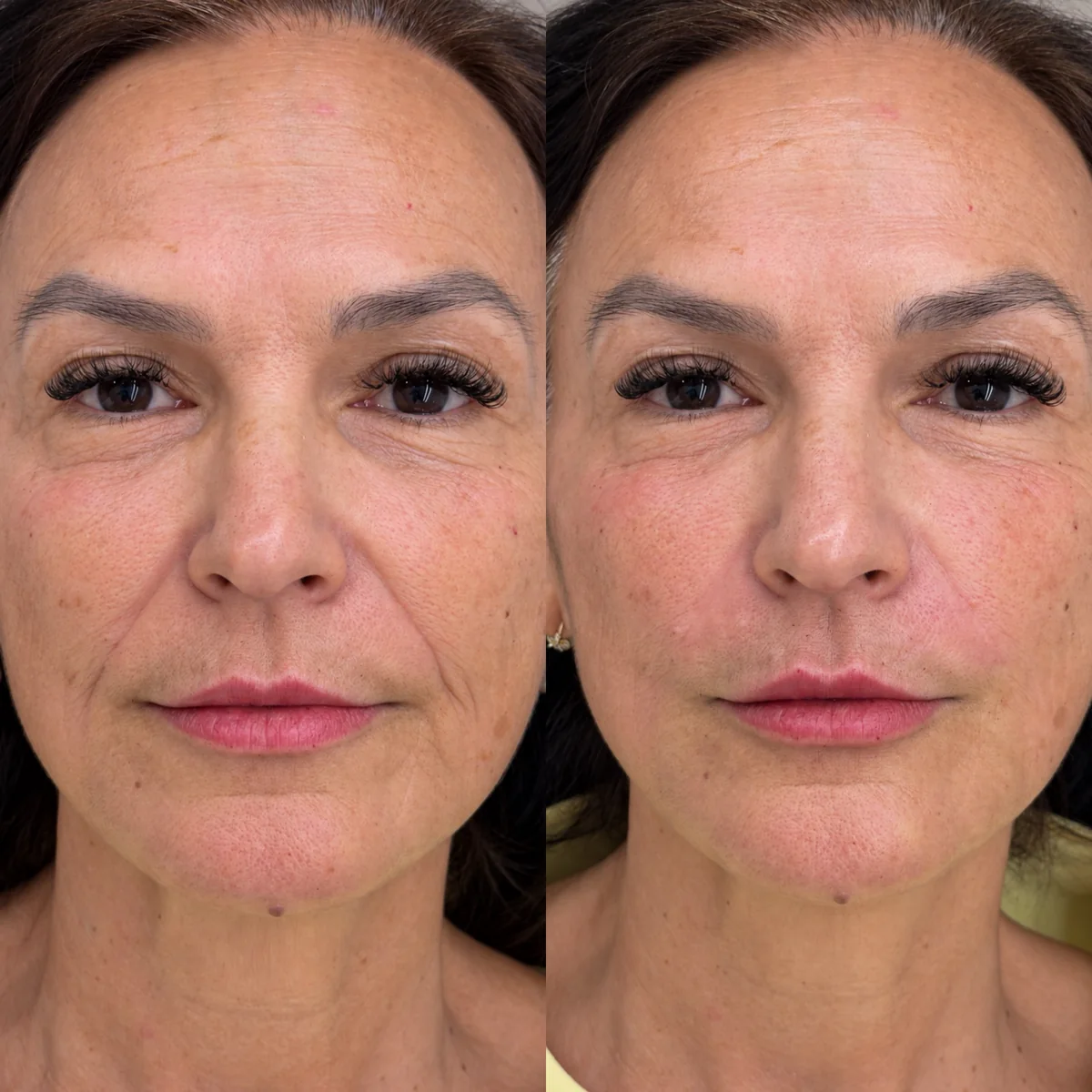 Antes e depois de preenchimento de bigode chinês: paciente de frente, com os sulcos entre o nariz e o canto da boca suavizados depois