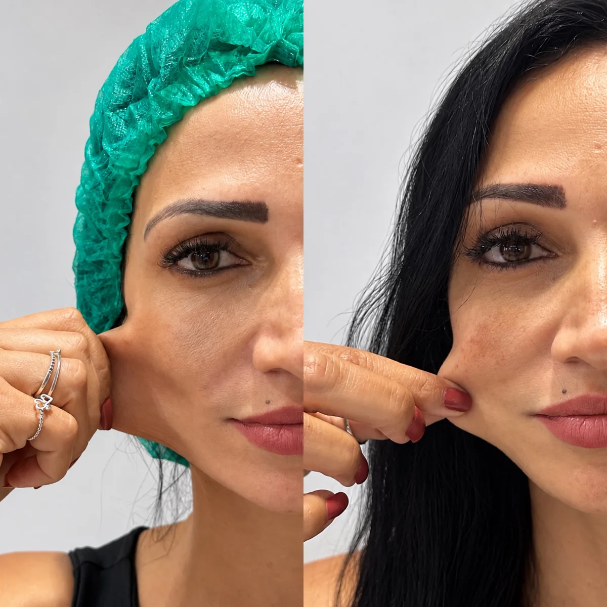 Antes e depois de bioestimulador de colágeno: paciente puxando a pele da bochecha para mostrar a firmeza antes e depois do tratamento