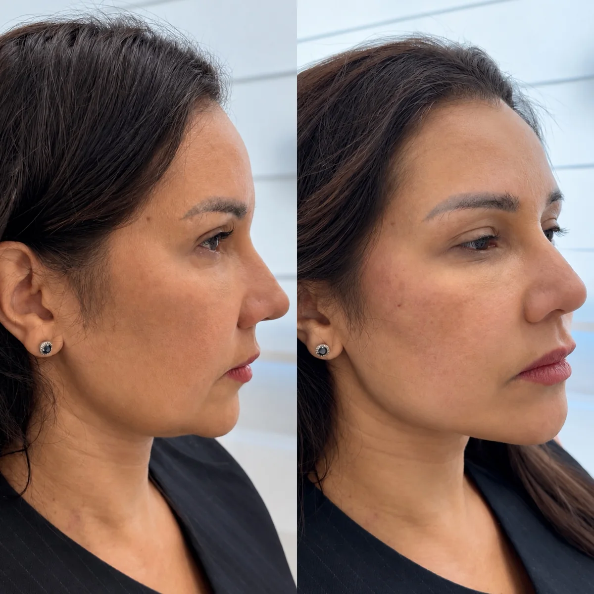 Antes e depois de fios de tração: paciente de perfil, com o contorno da mandíbula mais definido depois do procedimento