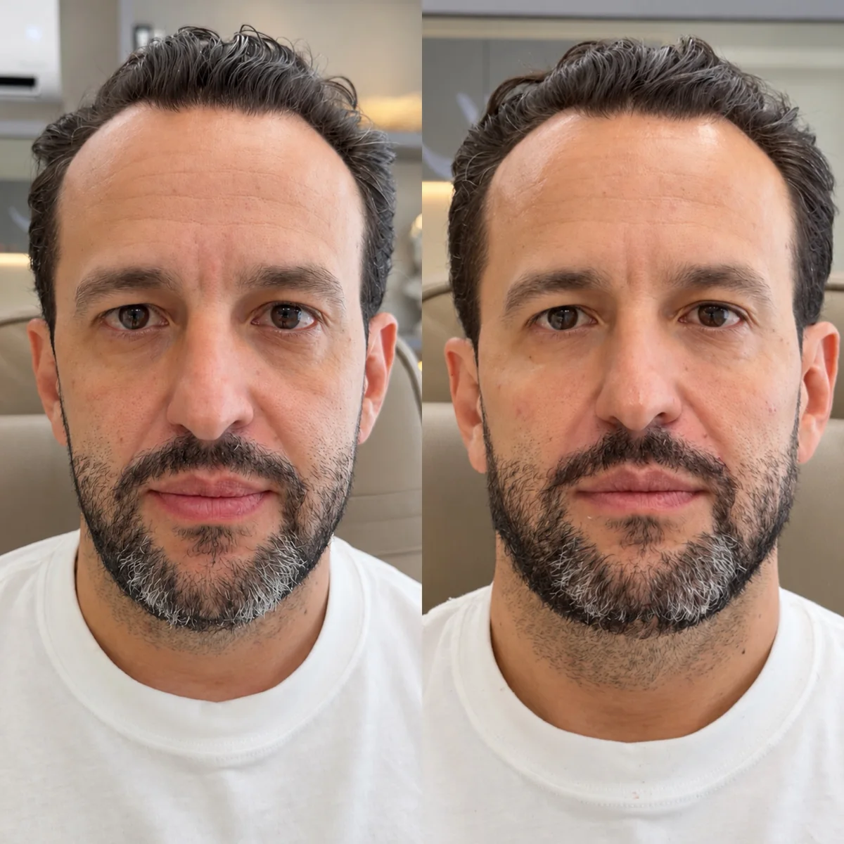 Antes e depois de harmonização facial em paciente masculino, de frente, com o contorno da mandíbula e do queixo mais definido depois