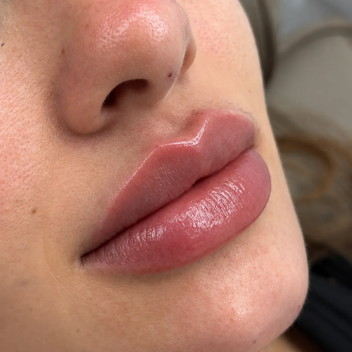 Lábios de paciente após preenchimento labial, em close de três quartos, com o contorno definido