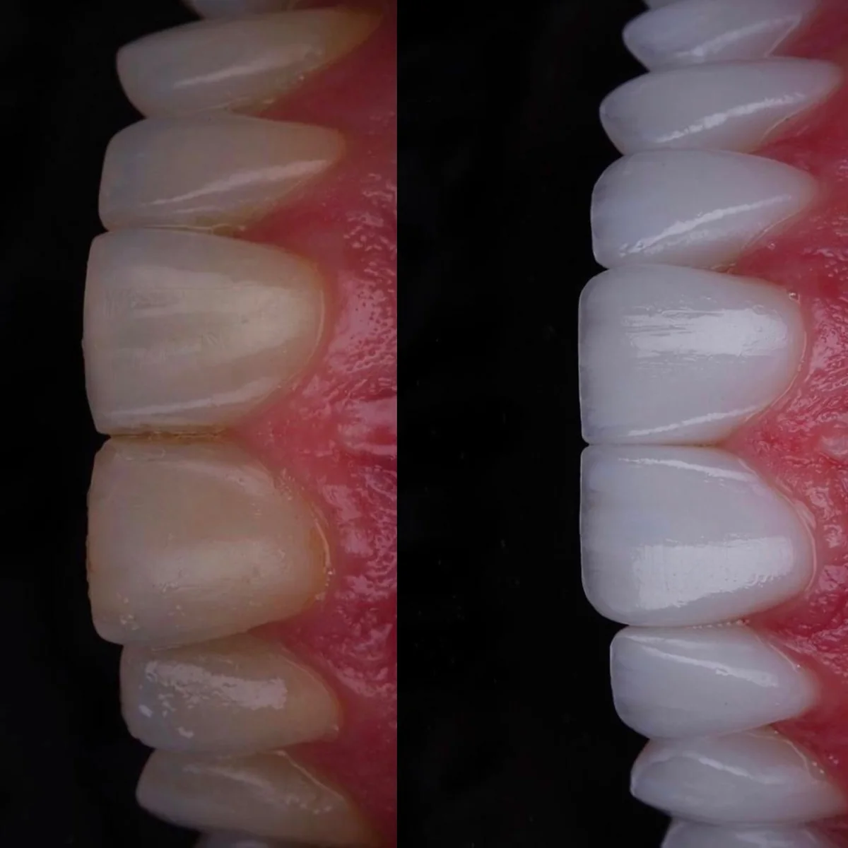 Antes e depois de lentes de contato de porcelana: dentes amarelados e desgastados antes e, depois, mais claros e com formato uniforme