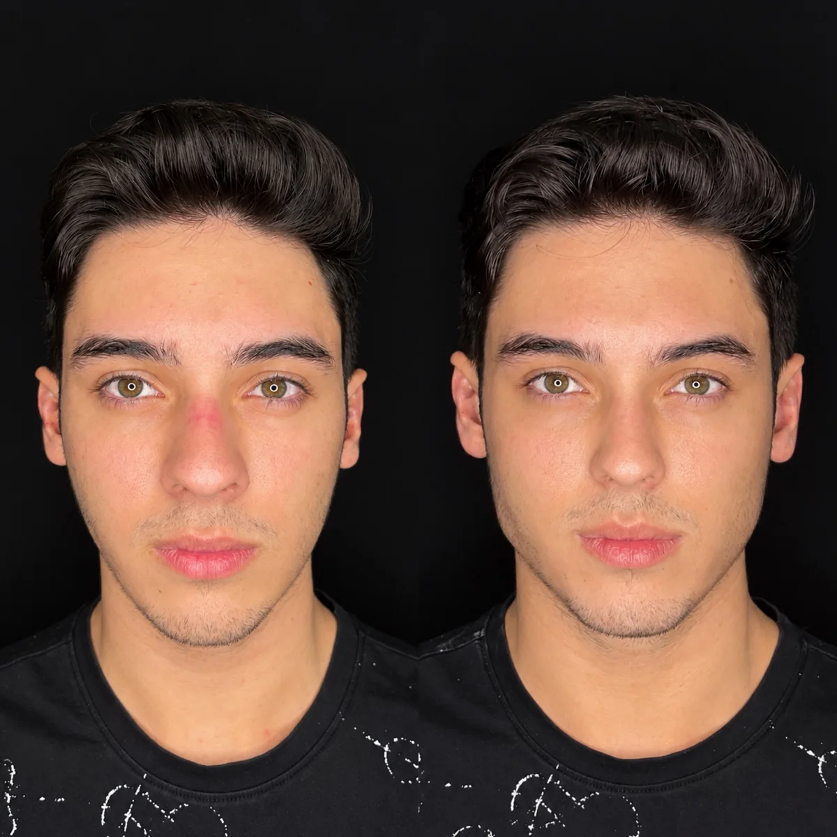 Antes e depois de preenchimento de mandíbula em paciente jovem, de frente, com o contorno do queixo e da mandíbula mais definido depois