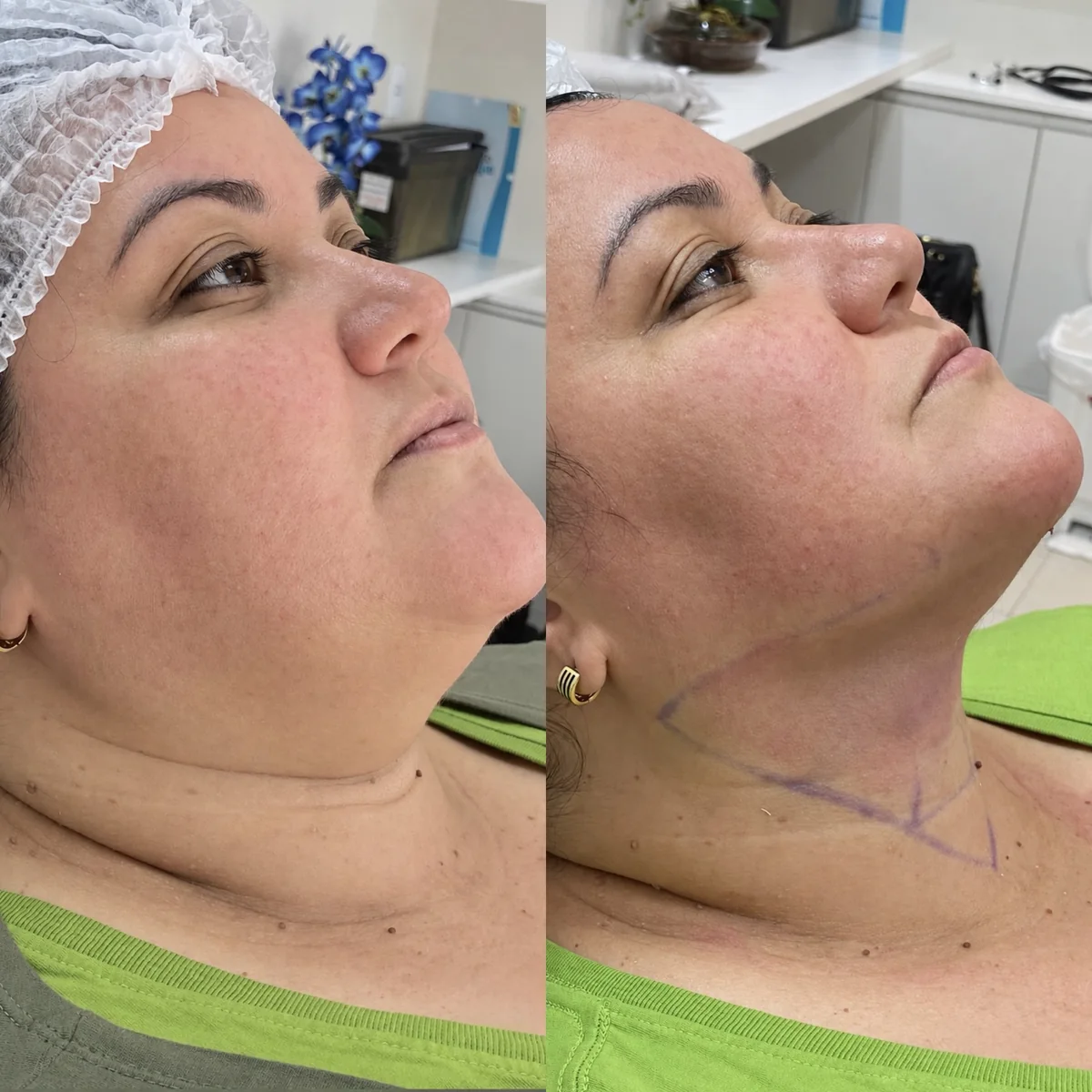 Antes e depois de lipo de papada: paciente com a cabeça inclinada para trás, mostrando o contorno entre o queixo e o pescoço