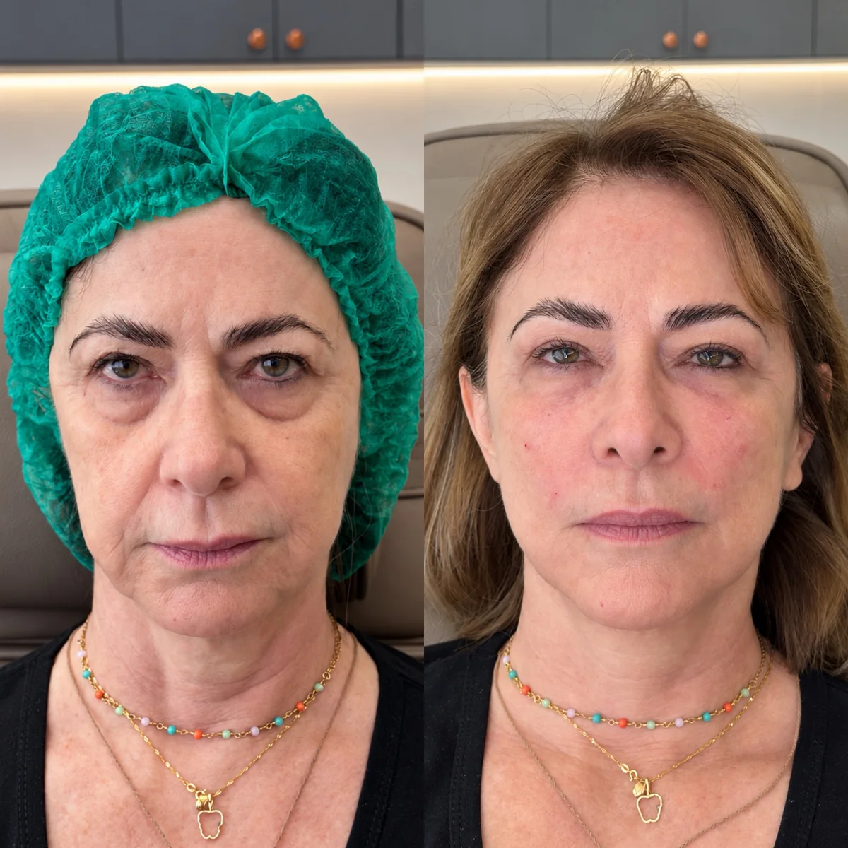 Antes e depois de reestruturação facial: paciente madura de frente, com olheiras, sulcos e contorno do rosto suavizados depois do tratamento