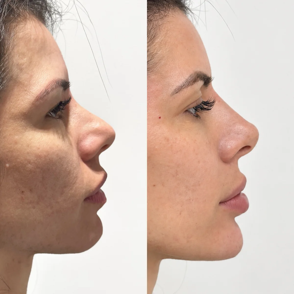 Antes e depois de rinomodelação: paciente de perfil, com o nariz mais alinhado depois do procedimento
