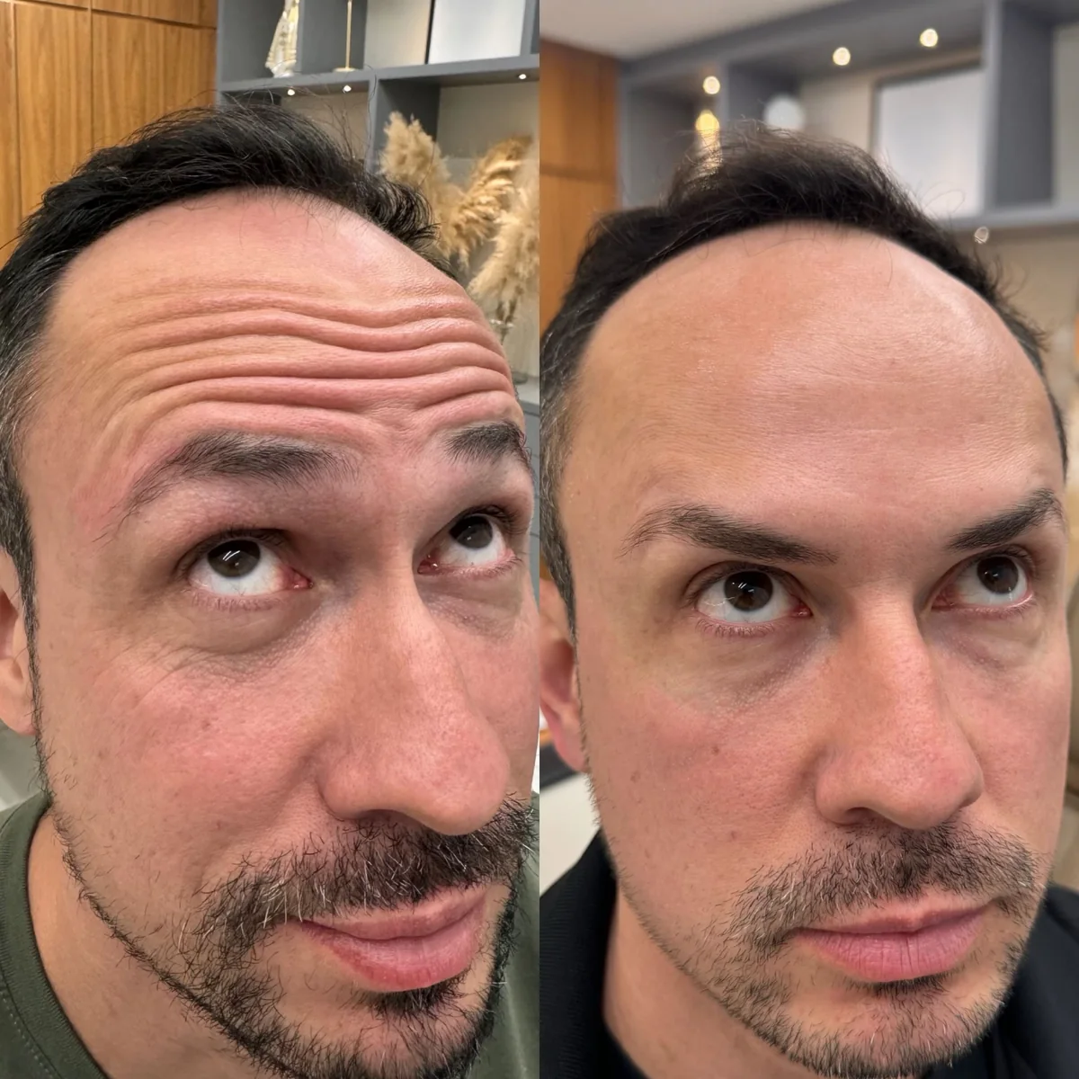 Antes e depois de toxina botulínica: paciente com as rugas da testa ao levantar as sobrancelhas e, depois, com a testa lisa